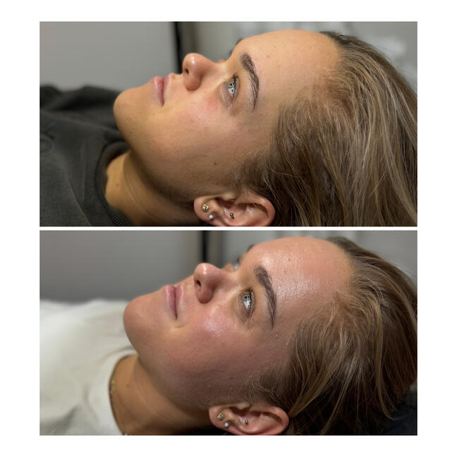 Mikrojehličkování